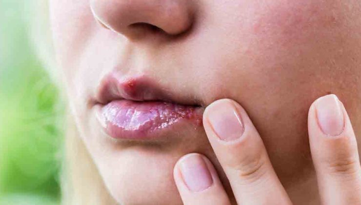Uçuk Nedir? Neden Çıkar ve Nasıl Geçer?