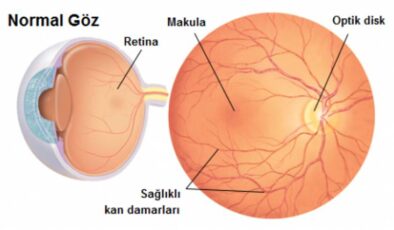 İkincil Hipertansiyon Retinayı Nasıl Etkiler?