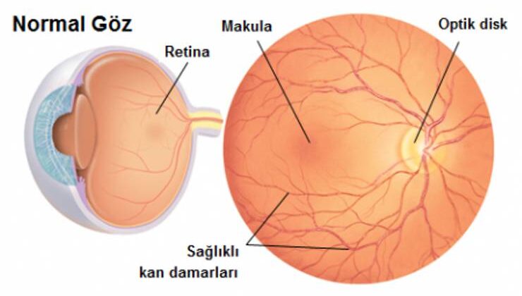 İkincil Hipertansiyon Retinayı Nasıl Etkiler?