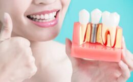 Dental İmplant (Diş Ekimi)