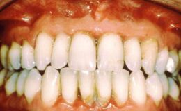 Diş Eti Hastalığının İltihabi Periodontitisin