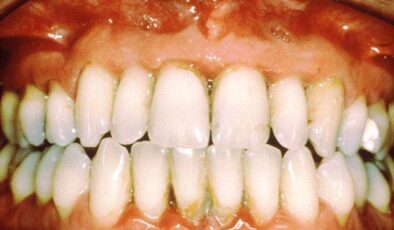 Diş Eti Hastalığının İltihabi Periodontitisin