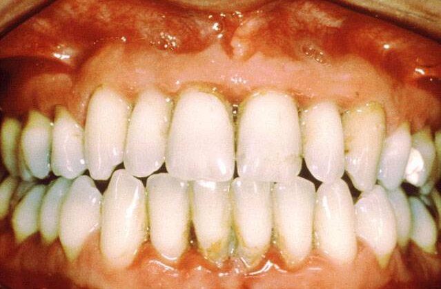 Diş Eti Hastalığının İltihabi Periodontitisin