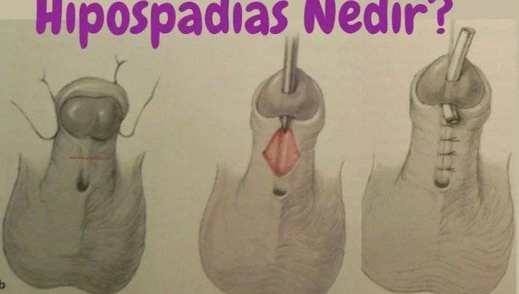 Hipospadias