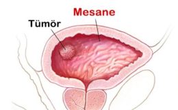 Mesane Tümörü , Mesane Tümörü Nedir , Mesane Tümörü Belirtileri