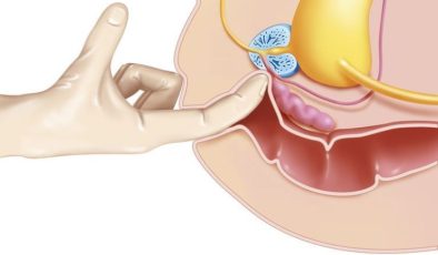 Parmakla prostat muayenesi her hastaya yapılıyor mu?