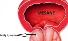 Prostat büyümesi BPH