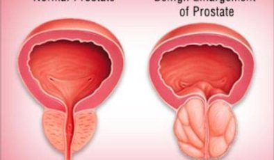 Prostat büyümesi belirtileri için ne zaman ürologa başvurmalı?