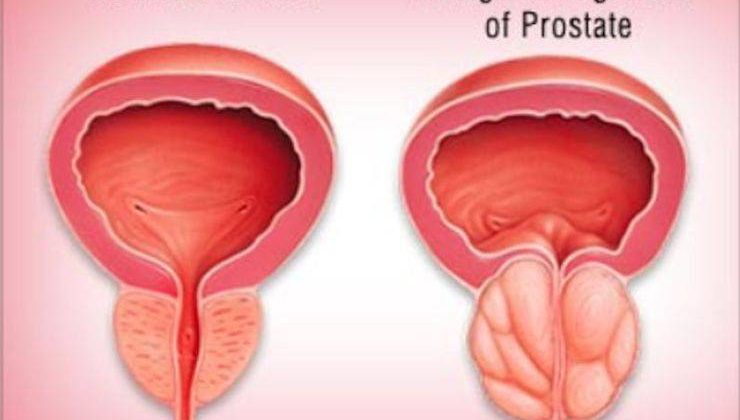 Prostat büyümesi belirtileri için ne zaman ürologa başvurmalı?