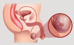 Testis Hastalıkları Nelerdir?