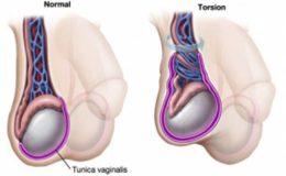 Testis Torsiyonu Nedir? Belirtileri Nelerdir?