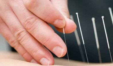 Akupunktur ve Alerji Tedavisi