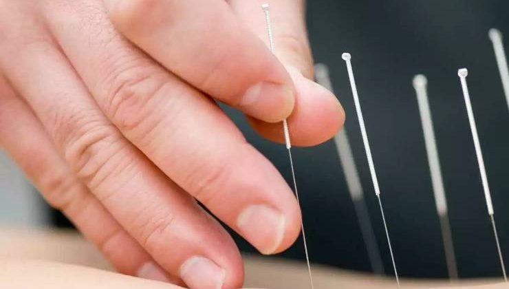 Akupunktur ve Alerji Tedavisi