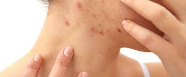 Alerjik Hastalıklar Nasıl Ortaya Çıkıyor?
