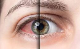 Allerjik Rinit (Saman Nezlesi) ve Allerjik Konjoktivit (Göz Allerjisi)