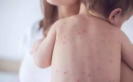 Çocuklarda Görülen Alerjik Hastalıklar