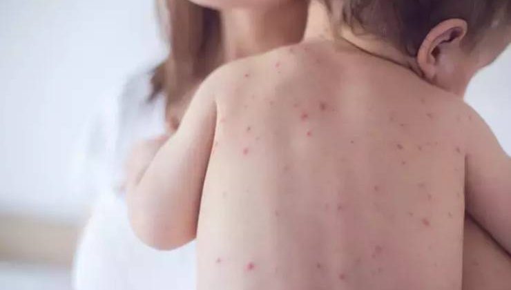 Çocuklarda Görülen Alerjik Hastalıklar