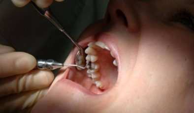 Diş Çürüklerinin 9 Nedeni