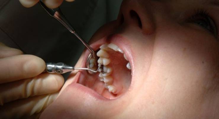 Diş Çürüklerinin 9 Nedeni