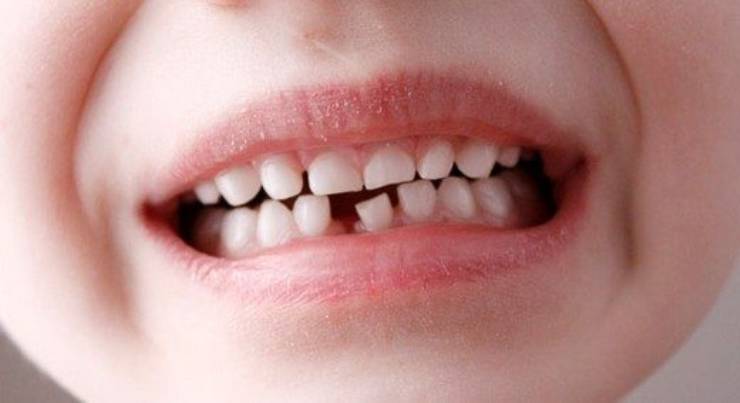 Diş eksikliğinin 8 zararı