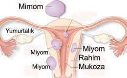 Myomların Değişik Tipleri Var Mıdır?