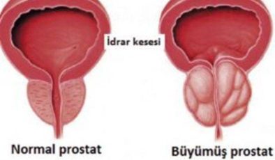 Prostat Hastalığını Nasıl Anlaşılır