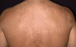 Tinea Versicolor