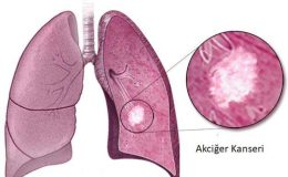 Akciğer kanseri hastalığı ve diğer kanser türleri