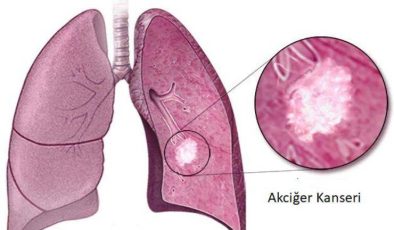 Akciğer kanseri hastalığı ve diğer kanser türleri