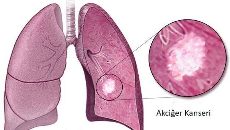 Akciğer kanseri hastalığı ve diğer kanser türleri