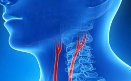 Boyun damarına takılan stent felce yol açabilir