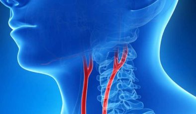 Boyun damarına takılan stent felce yol açabilir
