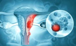 Kadın organlarının Kanser Hastalıkları