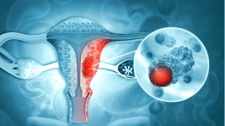 Kadın organlarının Kanser Hastalıkları
