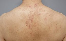 Keratosis Pilaris