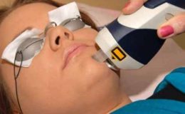 Lazer ile Cilt Soyma (Laser Resurfacing)