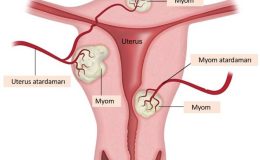 Myom nedir ? Nasıl tevavi edilir ?