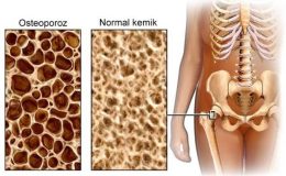 Osteoporoz (kemik erimesi)