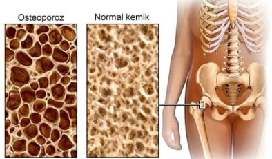 Osteoporoz (kemik erimesi)