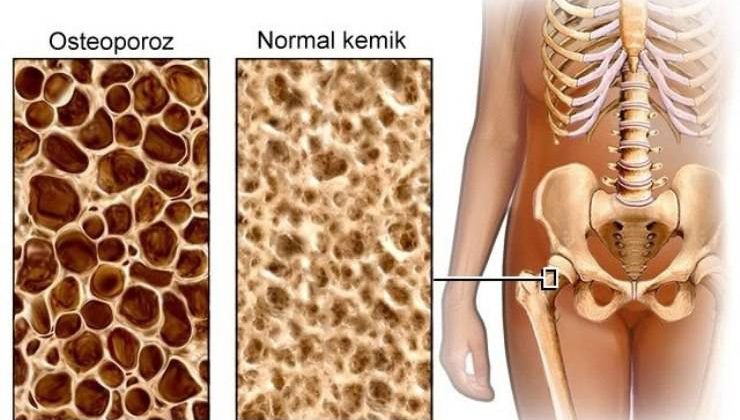 Osteoporoz (kemik erimesi)