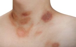 Pityriasis Rosea (Gül Hastalığı)