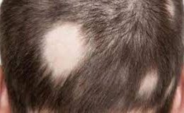 Saçkıran (Alopesi Areata)
