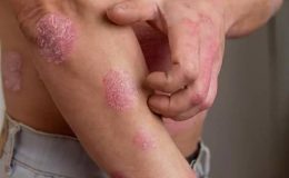 Sedef (Psoriasis)