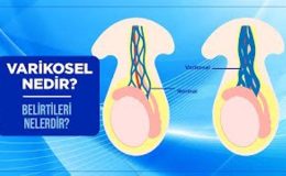 Varikosel Nedir? Tedavisi Nedir?