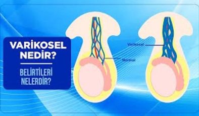 Varikosel Nedir? Tedavisi Nedir?