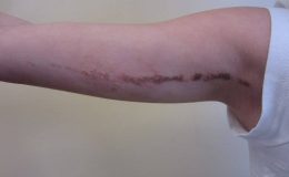 İLVEN (İnflamatuar lineer verruköz epidermal nevüs)