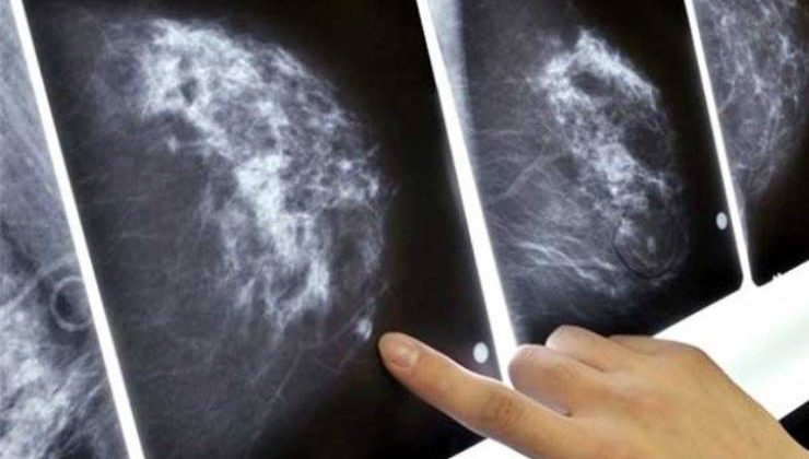 Meme Kanserine Karşı Düzenli Mamografi Şart