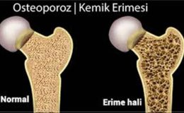 Menopozda Osteoporoz (Kemik Erimesi)