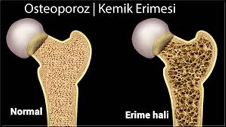 Menopozda Osteoporoz (Kemik Erimesi)