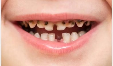 Çocuklar da Diş Çürüğü Neden Olur? Nelere Dikkat Edilmeli?